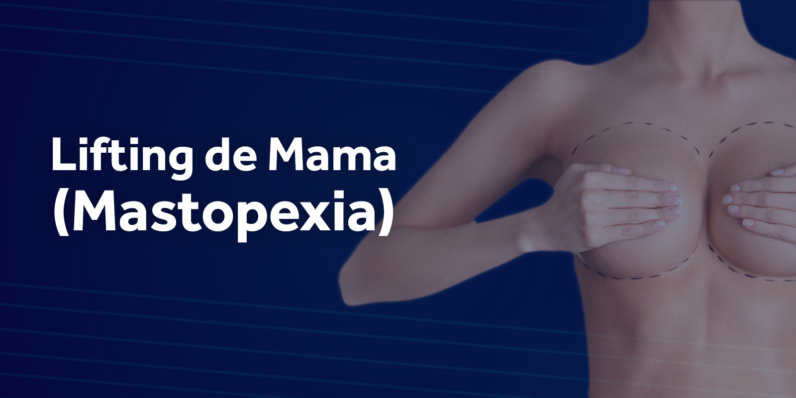 Lifting de Mama (Mastopexia)